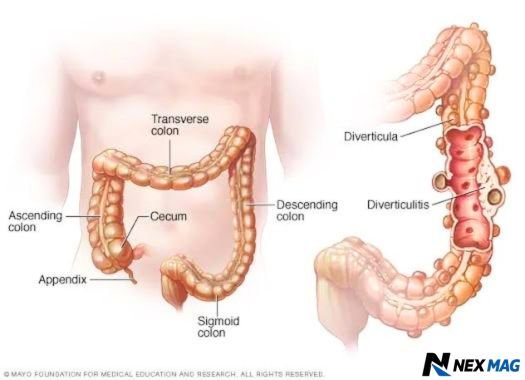 what does poop look like with diverticulitis